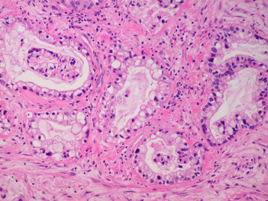 Neoplasms Clear Cell  -  8