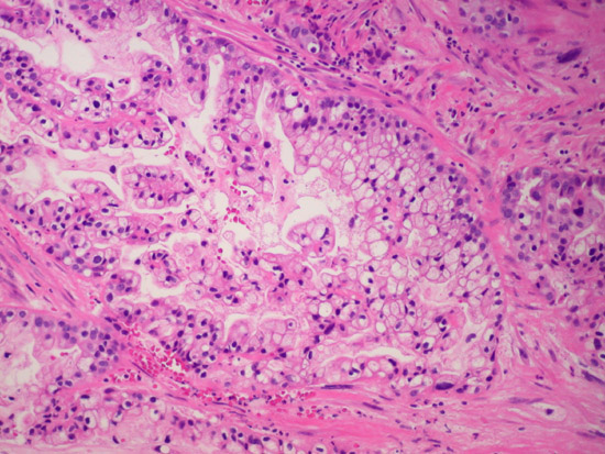 Clear cell carcinoma of Endometrium (2)