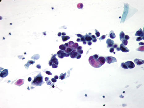 Pap smear taken from a 36-year-old woman, day 22 - slide 1. Click for larger image