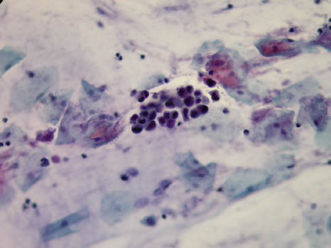 Pap smear taken from a 36-year-old woman, day 22 - slide 4. Click for larger image