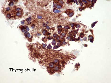 Fine needle aspiration biopsy of the thyroid, left lobe, in a 57-year-old male - slide 5 - click for larger image