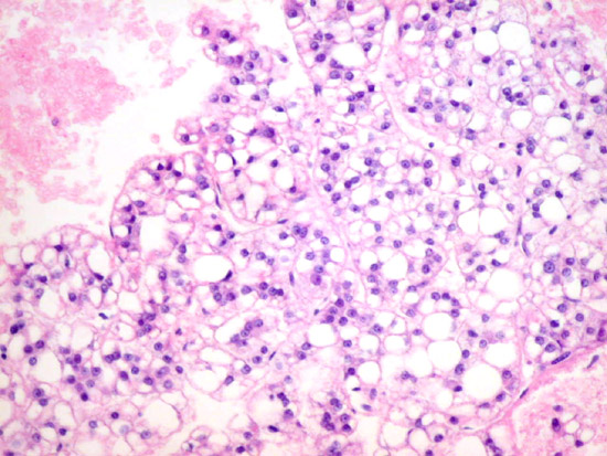 Neoplasms Clear Cell  -  5