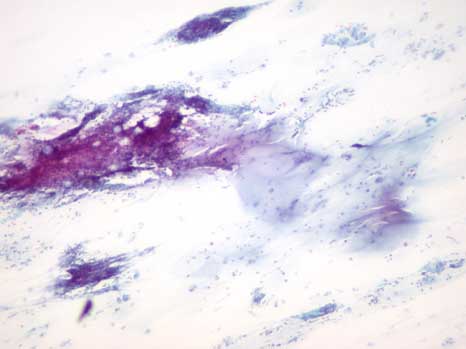 FNAB of a 1.5 cm firm, painless parotid lesion, present for 10 years in a 45-year-old man - slide 1 - click for larger version