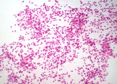 FNA of thyroid from a 45-year-old woman - slide 1 - click for larger version