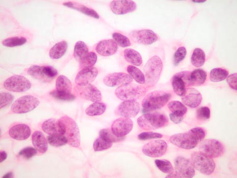 FNA of thyroid from a 45-year-old woman - slide 2 - click for larger version