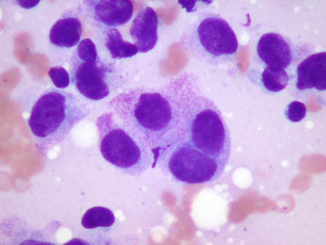 FNA of thyroid from a 45-year-old woman - slide 4 - click for larger version