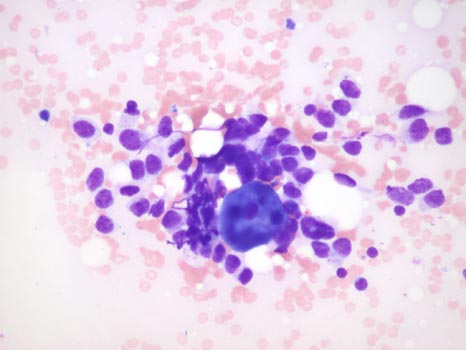 FNA of thyroid from a 45-year-old woman - slide 3 - click for larger version