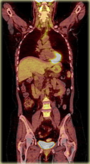 What a fused PET/CT scan looks like