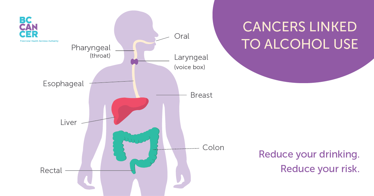 Cancers linked to alcohol