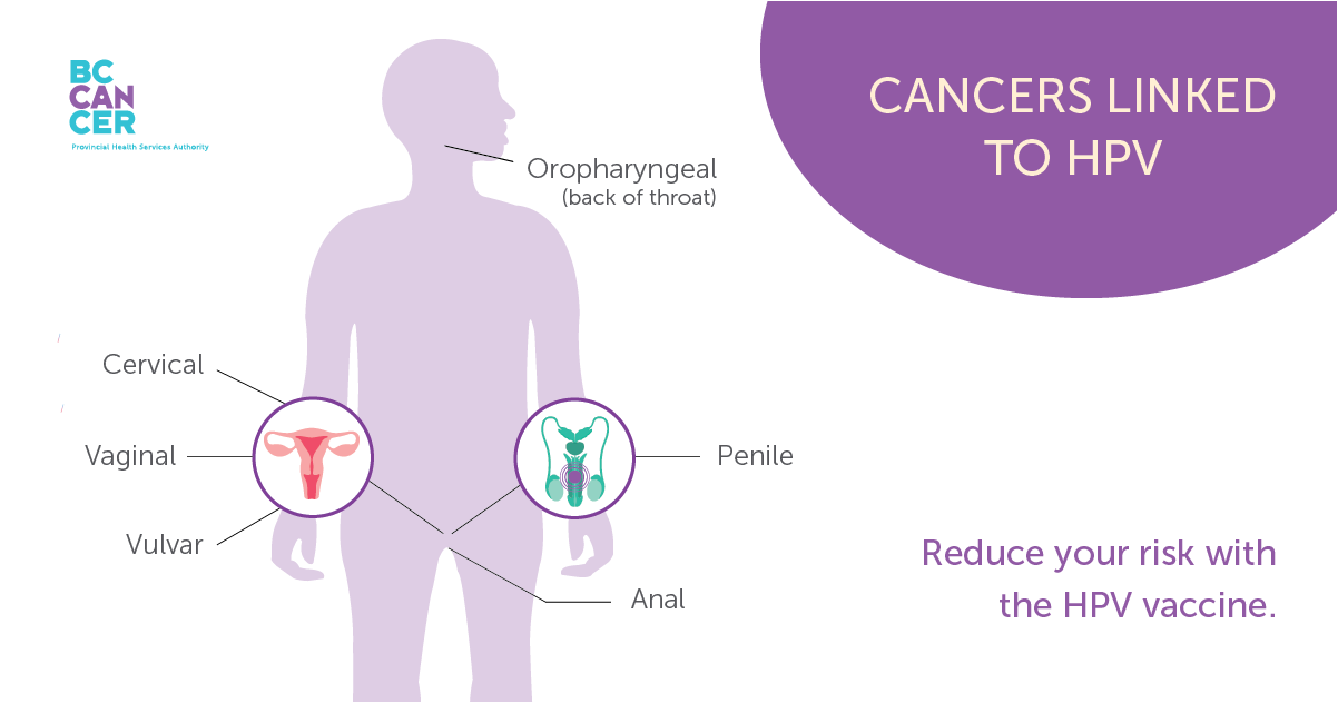 Cancers linked to human papillomavirus (HPV)