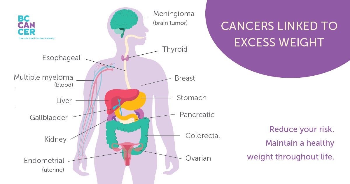 Cancers linked to excess weight