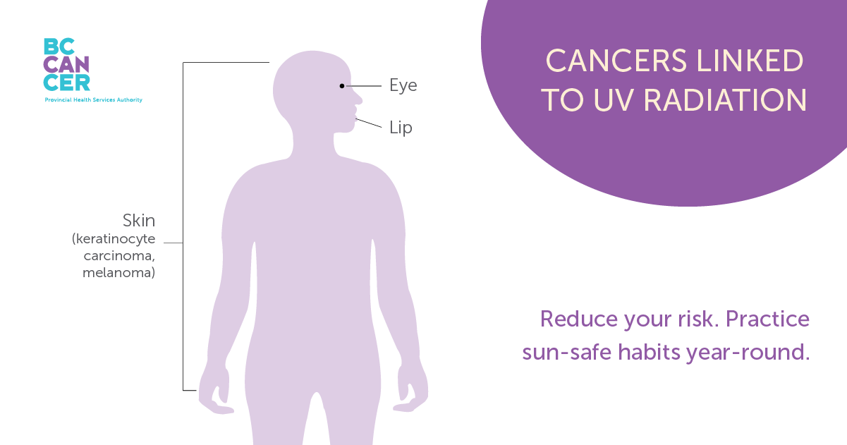 Cancers linked to ultraviolet radiation