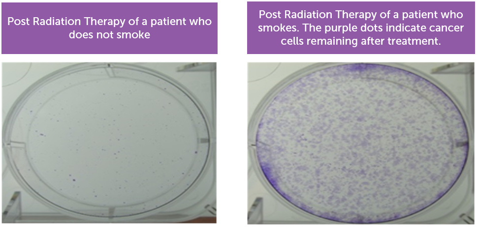 Comparison of cancer cells remaining in a patient who does not smoke and patient who smokes after completing radiation therapy