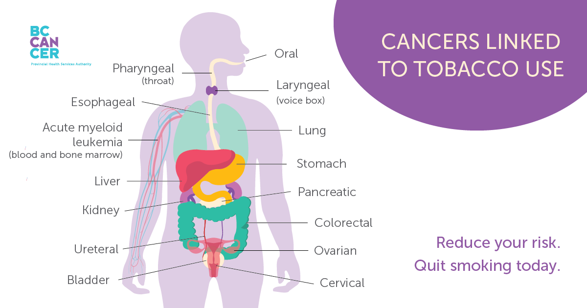 Cancers linked to tobacco use: oral, laryngeal (voice box), lung, stomach, pancreatic, colorectal, ovarian, cervical, pharyngeal (throat), esophageal, acute myeloid leukemia (blood, bone and marrow), liver, kidney, ureteral, bladder. Reduce your risk. Quit smoking today.