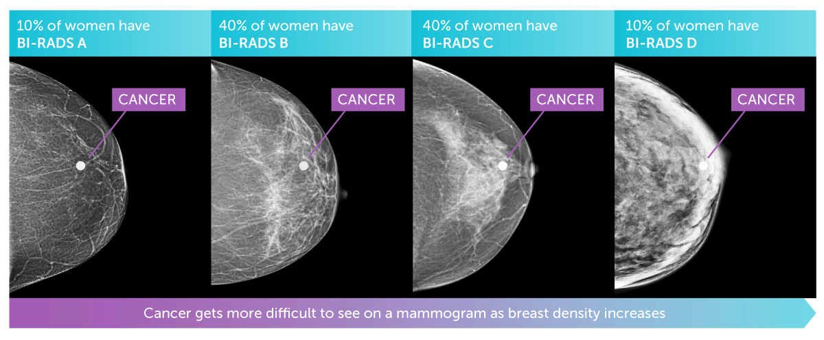 Image one: 10% of women have BI-RADS A - mammogram of breast with clear image of lump showing through less dense tissue. Image two: 40% of women have BI-RADS B - mammogram of breast with fairly clear image of lump showing through slightly dense tissue. Image 3 - 40% of women have BI-RADS C - mammogram of breast with hard-to-see lump in fairly desne tissue. Image 4: 10% of women have BI-RADS D - mammogram of breast with barely visible lump in very dense tissue.