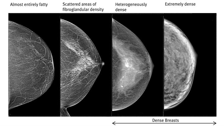 SMP_20170809_Breast Density Mammogram Illustration_V01-01.jpg