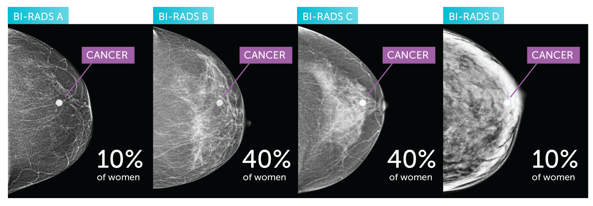 Breast Density Chart